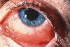 What is the clinical presentation of allergic conjunctivitis?