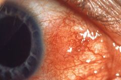 What's the clinical presentation of episcleritis?