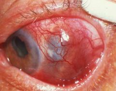 What is the clinical presentation of scleritis?