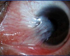 What's the clinical presentation of pterygium?