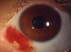 What does subconjunctival hemorrhage look like?