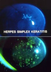 What's the clinical presentation of HSV keratitis?