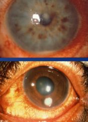 What's the clinical presentation of bacterial keratitis by gram positive organisms?