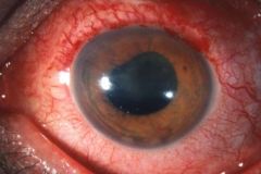 What's the clinical presentation of anterior uveitis/