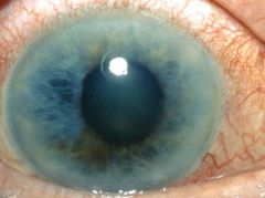 Disorders of the Anterior Ocular Segment Flashcards - Cram.com