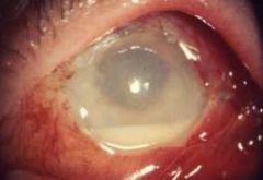 What's the clinical presentation of endophthalmitis?