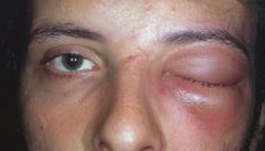 What's the clinical presentation of orbital cellulitis?