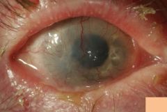 What are the ocular findings of acne roseacia?