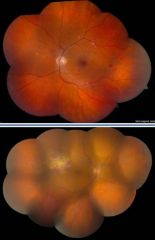 What are the findings on an eye exam during HIV retinopathy?