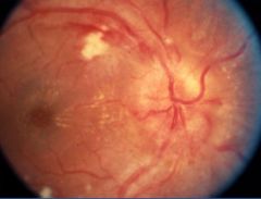 What does a retina look like during hypertensive retinopathy?