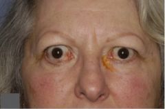 What are the signs of Graves disease?