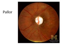 What is a cause of pallor of the optic disc?