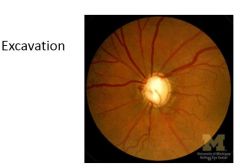 What is a cause of excavation to the optic disc?  What do you look for here?
