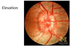 What is a cause of elevation of the optic disc?