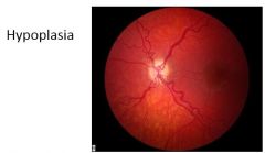 What is a cause of hypoplasia of the optic disc?