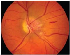What are the signs of non-arteritic ischemic optic neuropathy?