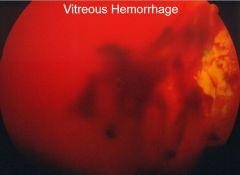 What does the retina look like in vitreous hemorrhage?