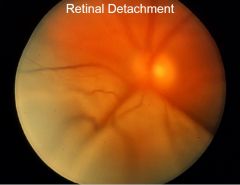 What does the retina look like if it's detached?