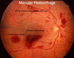 What does the eye look like if you've got macular hemorrhage?