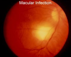 What does the eye look like in macular infection?