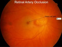 What does the eye look like in a retinal artery occlusion?