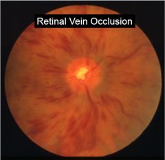 What does the eye look like if there's a retinal vein occlusion?