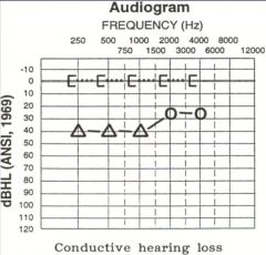 What does an audiogram look like for conductive hearing loss?