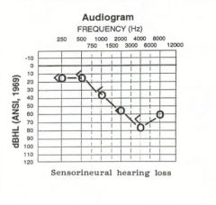 What does an audiogram look like for sensorineural hearing loss?