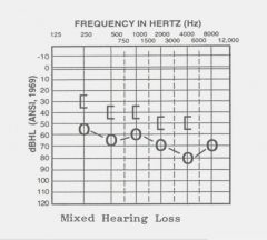 What happens in a mixed conduction loss?  What does the audiogram look like?