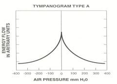 What does a normal tympanogram look like?