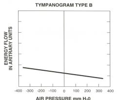 What does a tympanogram look like if there's a hole/fluid in the ear?