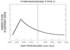 What will a tympanogram look like if the eustacian tube is dysfunctional?
