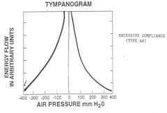 What does a tympanogram look like if there are problems with the tensor tympani/stapedius?