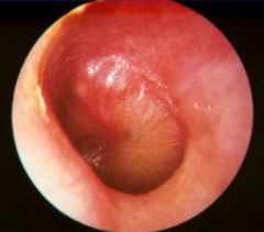 What does the tympanic membrane look like with acute suppurative otitis media?