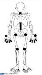 Cervical, lumbar spine

Upper: PIPs, DIP, base of thumb

Lower: hips, knees, 1st MT/Phalangeal joint