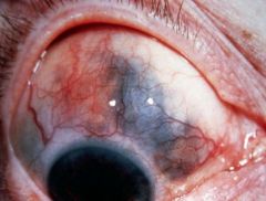 Keratoconjunctivits sicca (dry, inflamed eye)
Episcleritis
SCLERITIS (DANGEROUS - SEE PICTURE)
