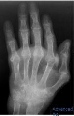 Bare areas, erosions
Uniform joint space narrowing
Absence of osteophytes
Symmetric
Periarticular, diffuse osteopenia
Periarticular swelling
Subluxations