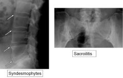 Sacroilitis and Syndesmophytes