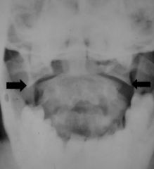 C1 ring fracture with lateral displacement of fragments

Caused by diving into shallow water