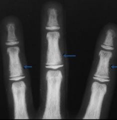 Hyperparathyroidism --> bone resorption

Osteoporosis
Osteosclerosis

Fuzzy margins of bone