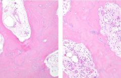 Mosaic lamellar bone (prominent cement/bluish lines)
HUGE OSTEOCLASTS!
Marrow fibrosis, hypervascularity