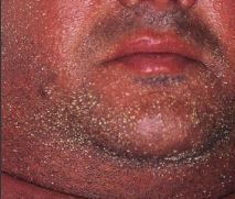 What are the small bumps on the man's face?