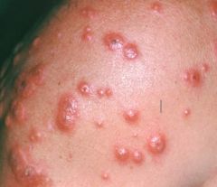 Brightly erythematous papulonodular lesions

Pseudovesiculations