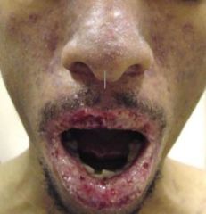 If someone in the middle of their life comes in with severe mucosal ulcerations, what should you think?