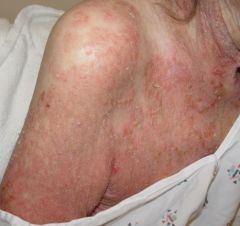 Skin lesions:
Scaly
Superficial
Crusted erosions

Looks like crusty corn flakes