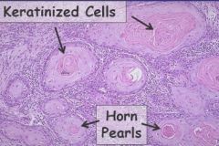 UV radiation/fair skin
immunosupression
Ulcers, scars
Environmentla toxins
Radiation
HPV
Genodermatoses