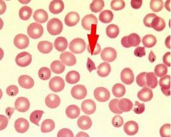 Shistocytes (RBC fragmentations)
Small RBCs (microcytes)

NO PLATELETS!