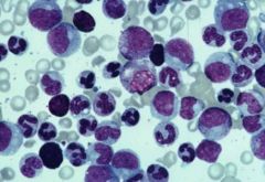 Abnormal differentiation from the outset; dysplastic precursors!  Things look odd.

Dysplastic cells in the marros; some are released to the the blood

Normal hematopoiesis is suppressed.

Some progression to acute leukemias