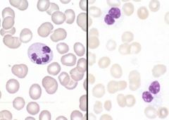 What is the cell type on the left?  What disorder is present on the right?