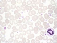 Increase in hemoglobin and hematocrit
Hypercellular bone marrow
Moderate leukocytosis/thrombocytosis

Decreased erythropoietin levels: hormone loop is intact